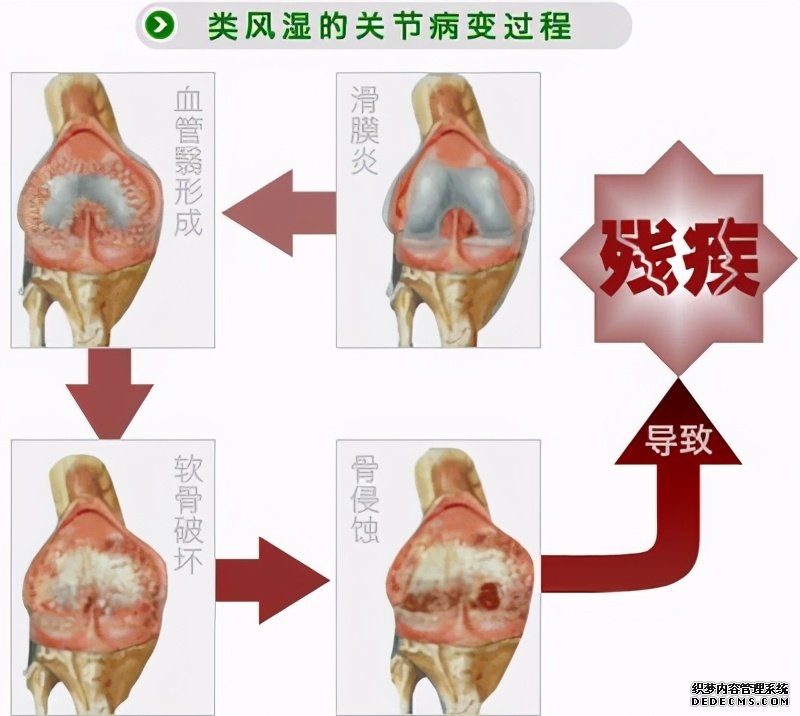 這些病癥你中了幾項(xiàng)？超過4項(xiàng)患類風(fēng)濕性關(guān)節(jié)炎的幾率極高