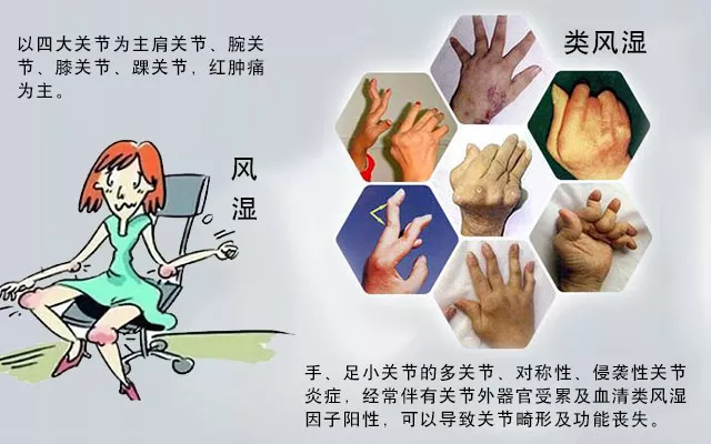 這些病癥你中了幾項(xiàng)？超過4項(xiàng)患類風(fēng)濕性關(guān)節(jié)炎的幾率極高