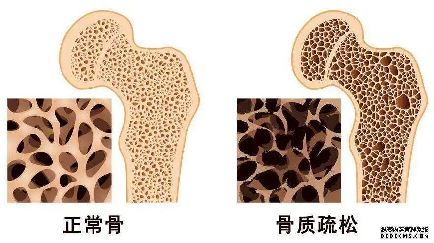 世界骨質(zhì)疏松日 | 預(yù)防“骨質(zhì)疏松”補(bǔ)鈣就可以了嗎？營(yíng)養(yǎng)專家送你一份“護(hù)骨秘籍”